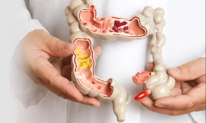 Colorectal Surgery