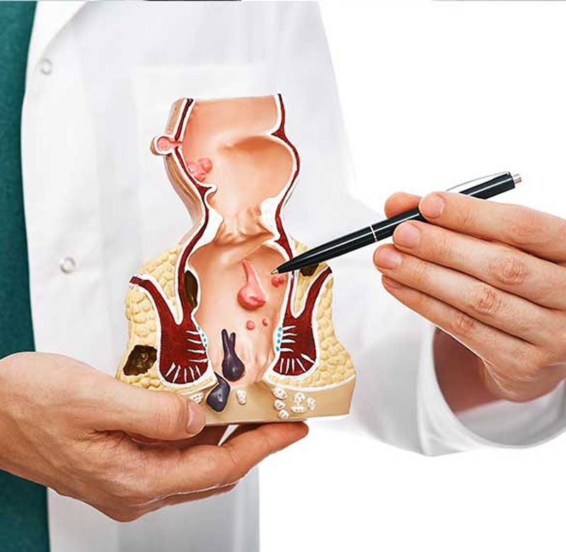 Laser Proctology Surgery